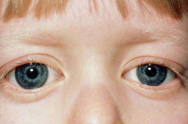 What Is Congenital Glaucoma? (Cause, Symptom & Treatment)